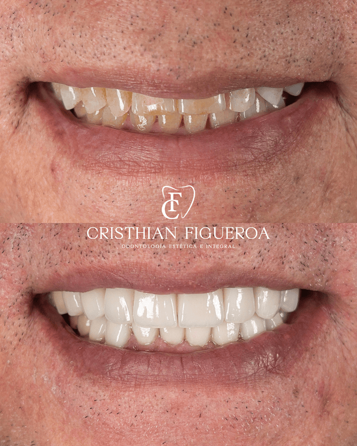 Odontologo Dr Cristhian Figueroa - Odontologia en Bucaramanga - Diseño de sonrisa