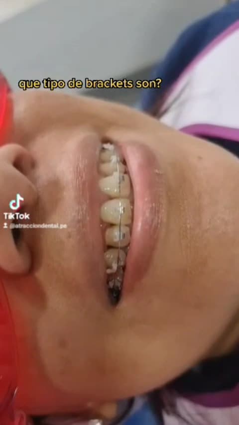Atracción Dental | Clínica Dental en Lima & Urgencias & Implantes & Alineadores Invisibles & Blanqueamiento & Brackets — foto