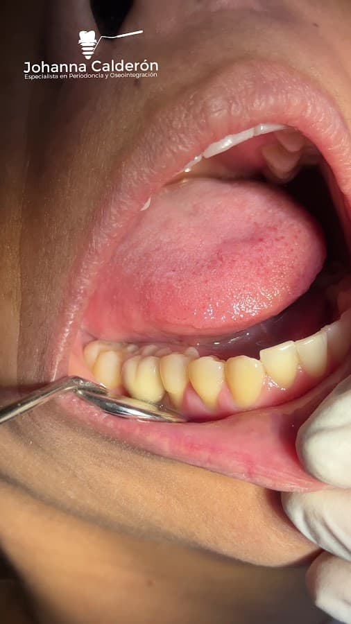 Periodoncia | Implantes dentales | Diseño de sonrisa Ibague Dra Johanna Calderón — foto