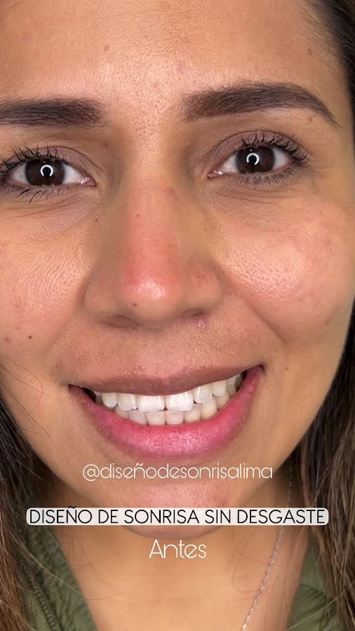 DISEÑO DE SONRISA LIMA — foto