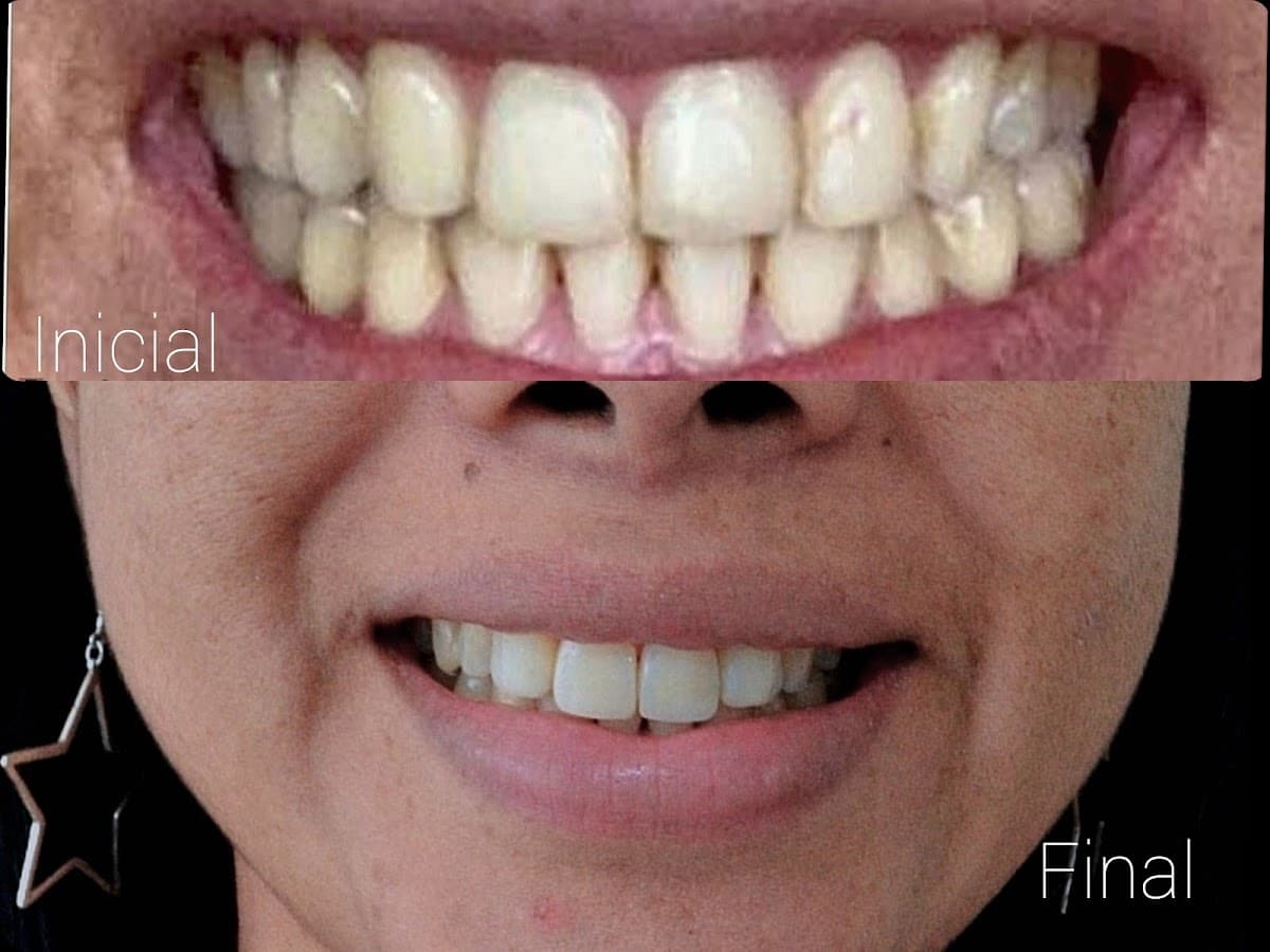 Beauty Dental | Puentes dentales en zirconio | diseño sonrisa