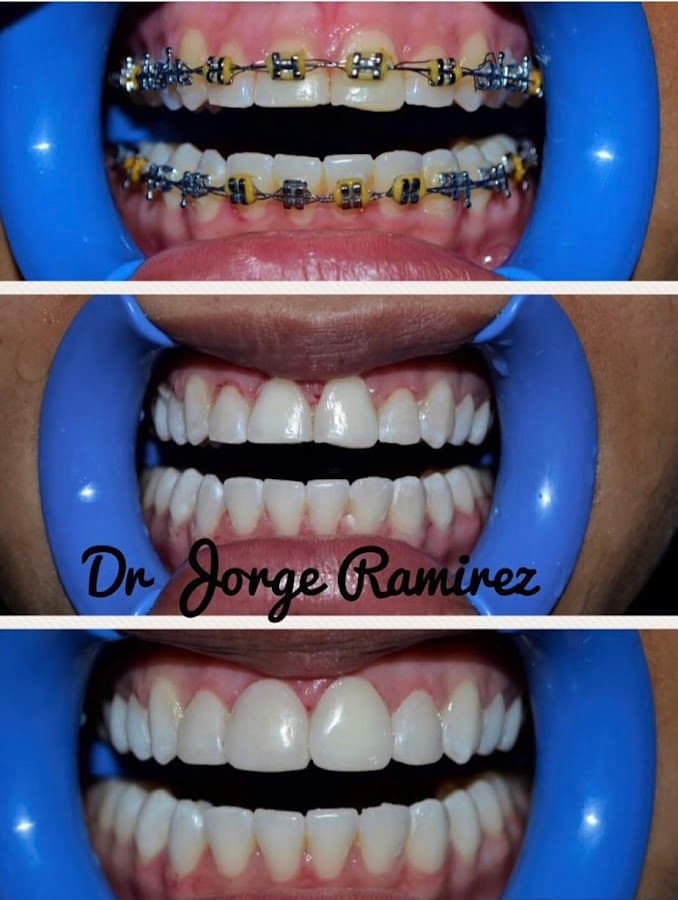 Beauty Dental | Puentes dentales en zirconio | diseño sonrisa — foto