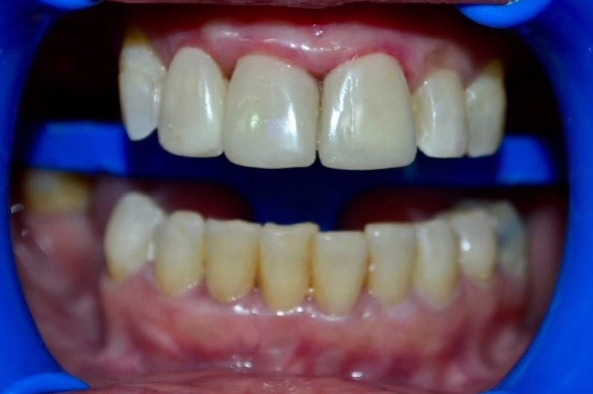 Beauty Dental | Puentes dentales en zirconio | diseño sonrisa — foto