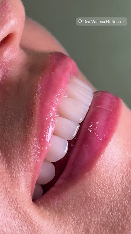 Consultorio Dra Vanesa Gutiérrez/odontologia/Estetica dental/clínica dental/implantes/diseño de sonrisa/Lentes cerámicos/ — foto