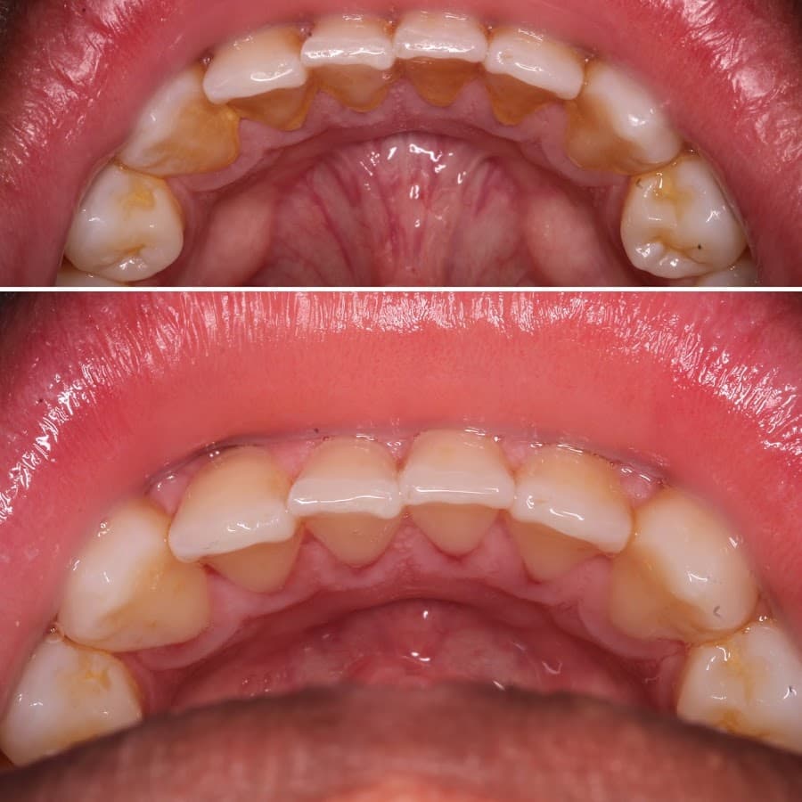 Impacto Dental Lima Cercado | Ortodoncia | Prótesis | Puentes de Porcelana — foto